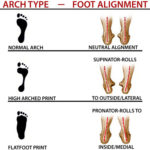 Symptoms and treatment for high and painful arches