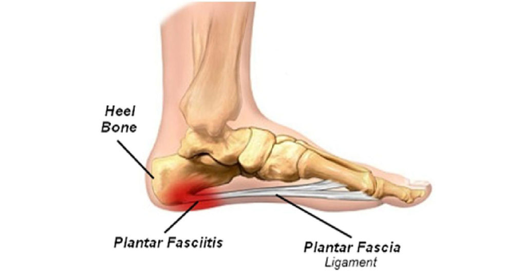 The Rise of Plantar Fasciitis– Everyone’s got it…but why? | Soles In Motion